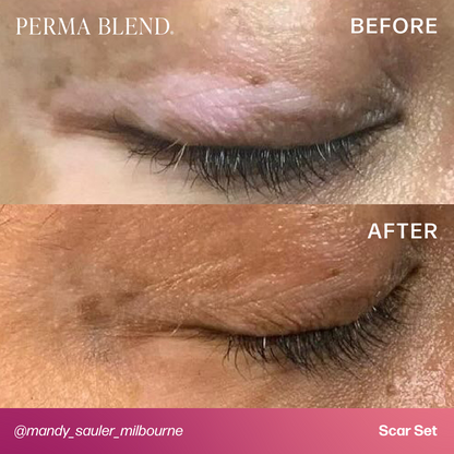 Light Dermis - Mandy Sauler Scar