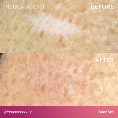 Light Dermis - Mandy Sauler Scar